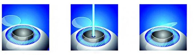Laser vision correction stages